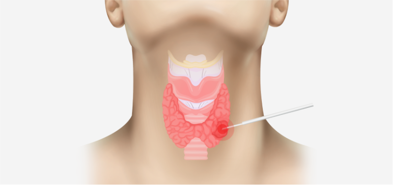 갑상선 혹 수술 대신 갑상선 고주파 시술도 가능한 경우 ㅣ서면하나유외과 사진 7